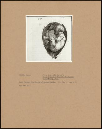 Plate From John Burton's Essay Towards A Complete New System Of Midwifery, 1751